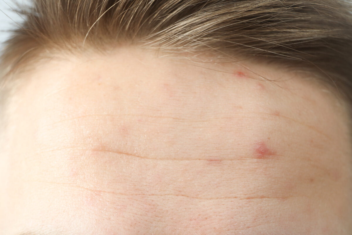 causes of forehead acne