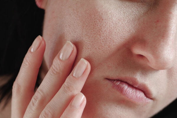 dry skin cause acne